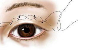 Chỉ nhấn mí thường được sử dụng là loại nào?
