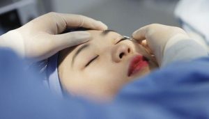 Đặc điểm phương pháp nhấn mí bằng chỉ