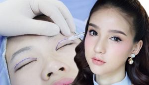 Vì sao chỉ nhấn mí bị tiêu hủy?