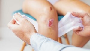 Hướng dẫn cách sơ cứu vết thương rách da đơn giản nhất